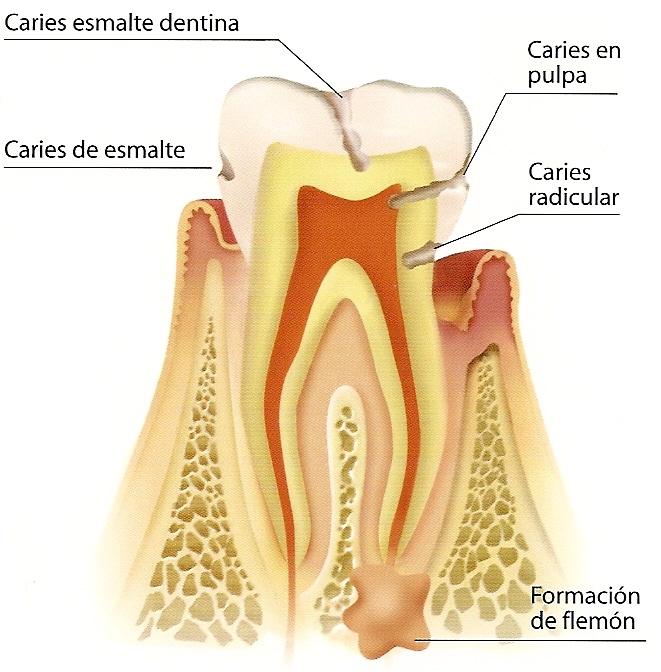Caries
