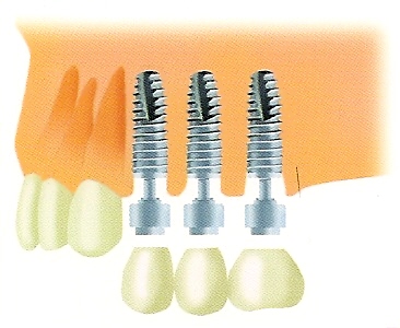 Tres Implantes