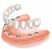 Varios Implantes