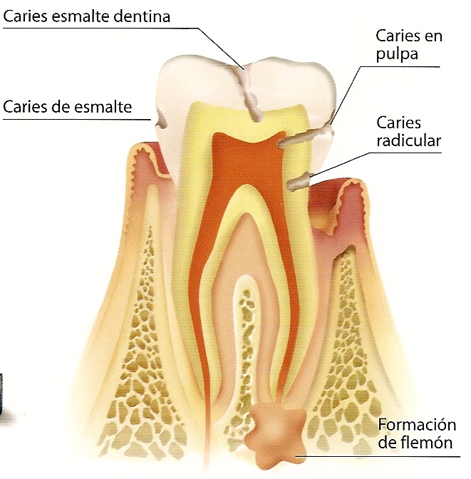 Caries